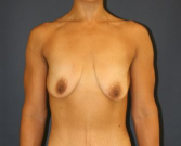 Feel Beautiful - Weight Loss Breast Lift - Before Photo